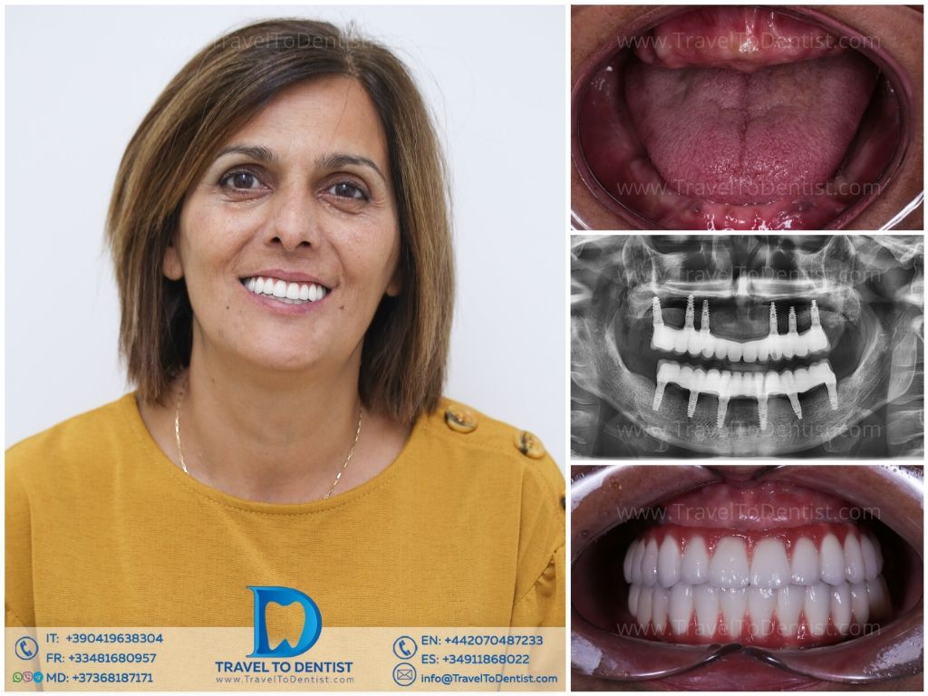 Caso dental 5 - Tratamiento periodontal