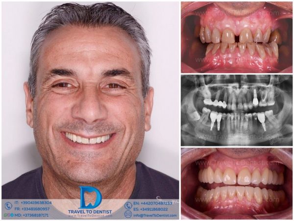 Caso dental 2 - Transformación dental